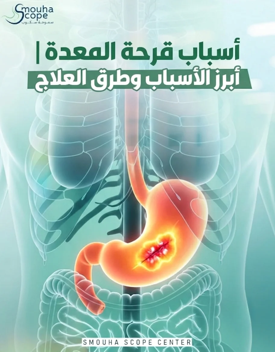 اسباب قرحة المعدة​
